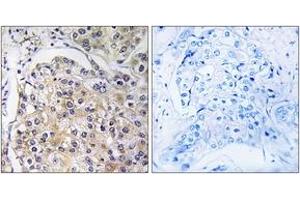Immunohistochemistry analysis of paraffin-embedded human breast carcinoma tissue, using GPR116 Antibody. (G Protein-Coupled Receptor 116 anticorps  (AA 1121-1170))