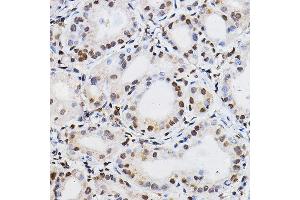 Immunohistochemistry of paraffin-embedded human thyroid cancer using PER2 Rabbit pAb (ABIN6131889, ABIN6145450, ABIN6145452 and ABIN6217063) at dilution of 1:100 (40x lens). (PER2 anticorps  (AA 1-150))
