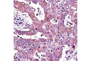 JAK2 antibody immunohistochemistry analysis in formalin fixed and paraffin embedded human lung adenocarcinoma.