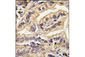 Formalin-fixed and paraffin-embedded human lung carcinoma tissue reacted with CSF1R Antibody (C-term), which was peroxidase-conjugated to the secondary antibody, followed by DAB staining. (CSF1R anticorps  (C-Term))