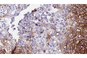 ABIN6274606 at 1/100 staining Human urothelial cancer tissue by IHC-P.