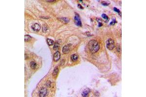 Immunohistochemical analysis of NF-kappaB p65 (pS529) staining in human lung cancer formalin fixed paraffin embedded tissue section.