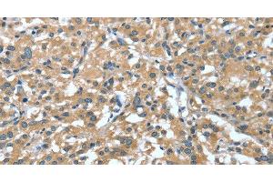 Immunohistochemistry of paraffin-embedded Human thyroid cancer tissue using DTX1 Polyclonal Antibody at dilution 1:30 (Deltex Homolog 1 anticorps)