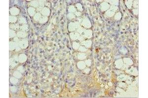 Immunohistochemistry of paraffin-embedded human colon cancer using ABIN7143999 at dilution of 1:100