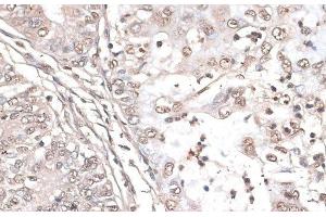 Immunohistochemistry of paraffin-embedded Human endometrium cancer using MEF2C Polyclonal Antibody at dilution of 1:100 (40x lens). (MEF2C anticorps)