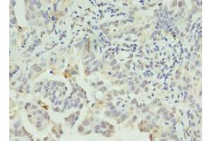 Immunohistochemistry of paraffin-embedded human lung cancer using ABIN7146041 at dilution of 1:100