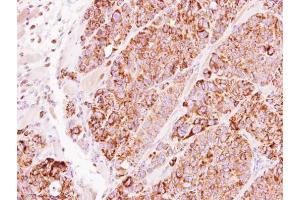 IHC-P Image Immunohistochemical analysis of paraffin-embedded SW480 xenograft, using TBRG4, antibody at 1:500 dilution. (TBRG4 anticorps)