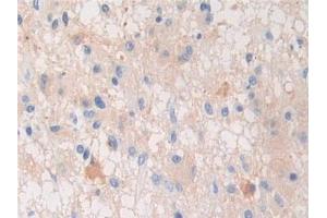 Detection of PZP in Human Glioma Tissue using Polyclonal Antibody to Pregnancy Zone Protein (PZP)