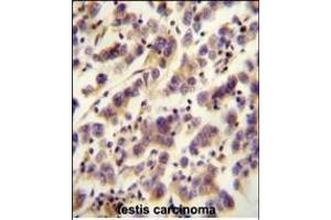 OR1J4 antibody (C-term) (ABIN655015 and ABIN2844648) immunohistochemistry analysis in formalin fixed and paraffin embedded human testis carcinoma followed by peroxidase conjugation of the secondary antibody and DAB staining. (OR1J4 anticorps  (C-Term))