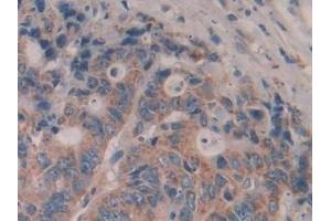 Detection of IL35 in Human Colorectal cancer Tissue using Polyclonal Antibody to Interleukin 35 (IL35)