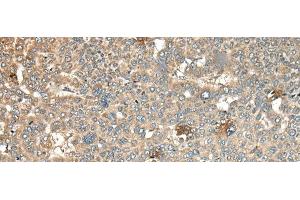 Immunohistochemistry of paraffin-embedded Human liver cancer tissue using CA11 Polyclonal Antibody at dilution of 1:45(x200) (CA11 anticorps)
