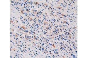 IHC-P analysis of stomach cancer tissue, with DAB staining. (GLDC anticorps  (AA 81-268))
