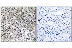 Immunohistochemistry analysis of paraffin-embedded human breast carcinoma tissue using USP19 antibody. (USP19 anticorps  (Internal Region))