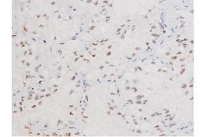 ABIN6267578 at 1/200 staining Human lung cancer tissue sections by IHC-P. (FOXO4 anticorps  (pThr451))