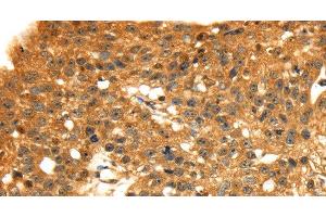 Immunohistochemistry of paraffin-embedded Human breast cancer tissue using STX8 Polyclonal Antibody at dilution 1:45 (STX8 anticorps)
