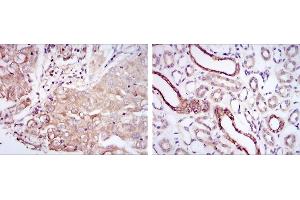 Immunohistochemical analysis of paraffin-embedded lung cancer tissues (left) and kidney tissues (right) using PODXL mouse mAb with DAB staining. (PODXL anticorps)