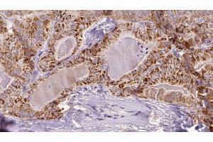 ABIN6273353 at 1/100 staining Human thyroid cancer tissue by IHC-P. (SLC7A11 anticorps)