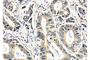 ABIN6264993 and ABIN6279791 at 1/100 staining Human pancreatic cancer by IHC-P.