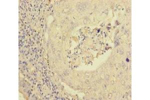 Immunohistochemistry of paraffin-embedded human lung cancer using ABIN7162979 at dilution of 1:100