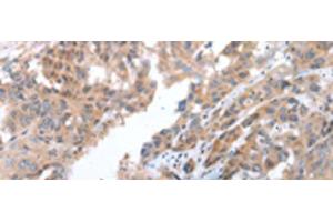Immunohistochemistry of paraffin-embedded Human breast cancer tissue using COX7C Polyclonal Antibody at dilution of 1:40(x200) (COX7C anticorps)