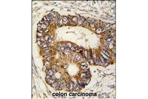 Formalin-fixed and paraffin-embedded human colon carcinoma tissue reacted with PHB2 Antibody  (ABIN391412 and ABIN2841409) , which was peroxidase-conjugated to the secondary antibody, followed by DAB staining. (Prohibitin 2 anticorps  (AA 106-134))