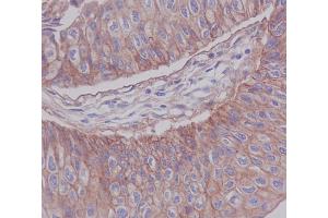 Immunohistochemical analysis of paraffin-embedded human blader cancer, using JAM1 Antibody.