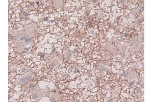 DAB staining on IHC-P; Samples: Human Glioma Tissue)