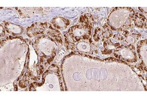 ABIN6267201 at 1/100 staining Human thyroid cancer tissue by IHC-P. (TRAF2 anticorps  (pSer11))
