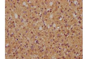 IHC image of ABIN7174981 diluted at 1:200 and staining in paraffin-embedded human glioma cancer performed on a Leica BondTM system. (Myosin XVIIIA anticorps  (AA 1849-2054))