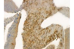 ABIN6261269 and ABIN6268950 at 1/100 staining human colon carcinoma by IHC-P.