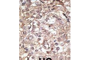 Formalin-fixed and paraffin-embedded human cancer tissue reacted with the primary antibody, which was peroxidase-conjugated to the secondary antibody, followed by AEC staining. (TLR1 anticorps  (C-Term))