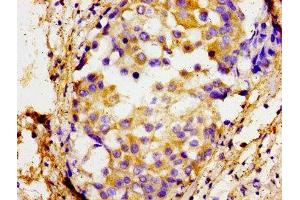Immunohistochemistry of paraffin-embedded human breast cancer using ABIN7172602 at dilution of 1:100