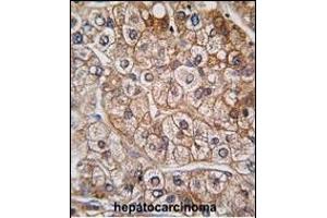 Formalin-fixed and paraffin-embedded human hepatocarcinoma tissue reacted with BR2 antibody (N-term), which was peroxidase-conjugated to the secondary antibody, followed by DAB staining.