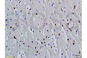 Formalin-fixed and paraffin embedded human hepatoma labeled with Anti-phospho-CDKN2A/p16-INK4a (Ser140) Polyclonal Antibody, Unconjugatedfollowed by conjugation to the secondary antibody and DAB staining