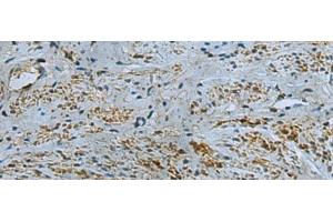 Immunohistochemistry of paraffin-embedded Human cervical cancer tissue using IL17RD Polyclonal Antibody at dilution of 1:40(x200) (IL17RD anticorps)