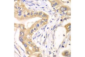 Immunohistochemistry of paraffin-embedded human liver cancer using HAGH antibody at dilution of 1:100 (x40 lens). (HAGH anticorps)