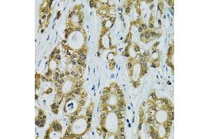 Immunohistochemistry of paraffin-embedded human rectal cancer using RPS7 antibody. (RPS7 anticorps  (AA 1-194))
