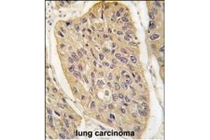 Formalin-fixed and paraffin-embedded human lung carcinoma tissue reacted with WIF1 (Human C-term) (ABIN389184 and ABIN2839347) , which was peroxidase-conjugated to the secondary antibody, followed by DAB staining. (WIF1 anticorps  (N-Term))