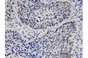 Immunoperoxidase of monoclonal antibody to HNF1B on formalin-fixed paraffin-embedded human lung adenocarcinoma. (HNF1B anticorps  (AA 29-118))