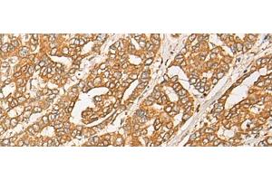 Immunohistochemistry of paraffin-embedded Human liver cancer tissue using GNB1L Polyclonal Antibody at dilution of 1:35(x200) (GNB1L anticorps)