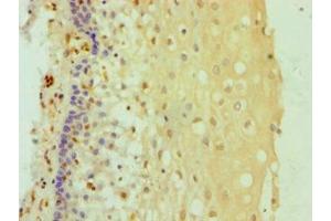 Immunohistochemistry of paraffin-embedded human cervical cancer using ABIN7144985 at dilution of 1:100