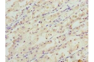 Immunohistochemistry of paraffin-embedded human gastric cancer using ABIN7166006 at dilution of 1:100 (RER1 anticorps  (AA 85-139))