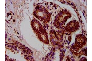 IHC image of ABIN7168291 diluted at 1:400 and staining in paraffin-embedded human breast cancer performed on a Leica BondTM system. (MOV10L1 anticorps  (AA 336-425))