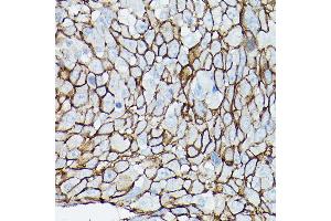 Immunohistochemistry of paraffin-embedded human urothelial carcinoma using δ-Catenin/p120 Catenin Rabbit pAb (ABIN3022308, ABIN3022309, ABIN3022310, ABIN1512791 and ABIN6218725) at dilution of 1:50 (40x lens). (CTNND1 anticorps  (AA 573-832))