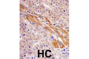 Formalin-fixed and paraffin-embedded human hepatocellular carcinoma reacted with PGK1 polyclonal antibody  , which was peroxidase-conjugated to the secondary antibody, followed by DAB staining. (PGK1 anticorps  (Internal Region))