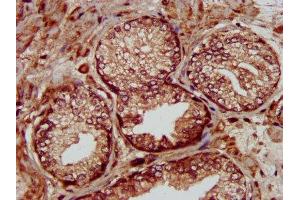 IHC image of ABIN7159657 diluted at 1:300 and staining in paraffin-embedded human prostate cancer performed on a Leica BondTM system.