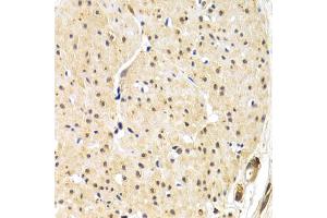 Immunohistochemistry of paraffin-embedded human gastric cancer using TERF1 antibody. (TRF1 anticorps)