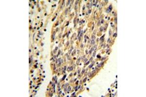 Formalin fixed, paraffin embedded human lung carcinoma stained with KM2 Antibody (N-term) followed by peroxidase conjugation of the secondary antibody and DAB staining. (PKM2 anticorps  (N-Term))