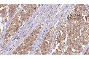 ABIN6275304 at 1/100 staining Human Melanoma tissue by IHC-P. (Neuromedin U anticorps  (C-Term))