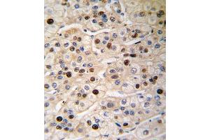 Formalin-fixed and paraffin-embedded human hepatocarcinoma tissue reacted with PCNA antibody (Center) (ABIN389345 and ABIN2839454) , which was peroxidase-conjugated to the secondary antibody, followed by DAB staining. (PCNA anticorps  (AA 89-117))